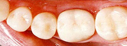 銀歯を白い歯に変えるメリット